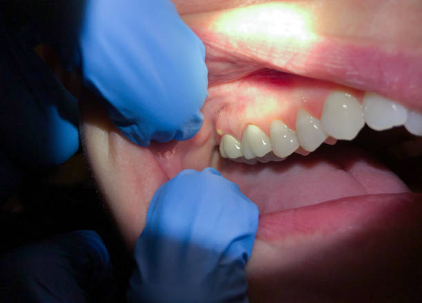Best Emergency Dental Care for Broken or Chipped Teeth in Harrisville, WV