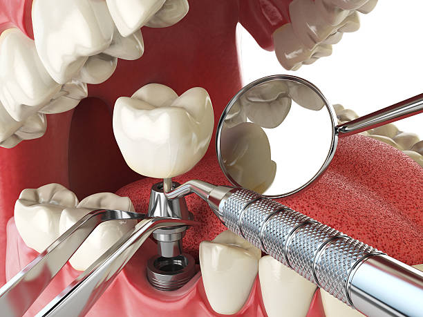 Best Emergency Root Canal Treatment in Harrisville, WV